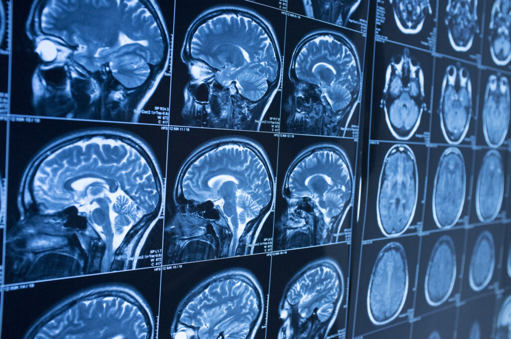 4 Types of Brain Injuries and 3 Levels of Severity | Zaner Harden Law, LLP